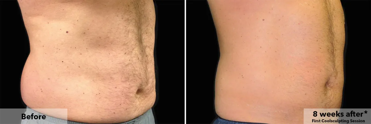CoolSculpting before and after, published example, Square Mile Clinic, City of London CoolSculpting abdomen before and 8 weeks after the first session, published example, CoolSculpting at Square Mile Clinic
