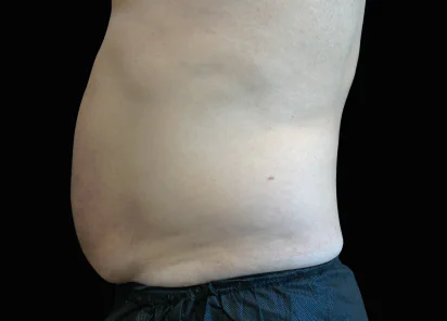 EMSCULPT NEO before and after, published example, Square Mile Clinic, City of London EMSCULPT NEO after treatment example, published by BTL, for EMSCULPT NEO at Square Mile Clinic, London